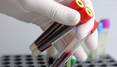 Wie man Tests von Parasiten im Körper durchnimmt