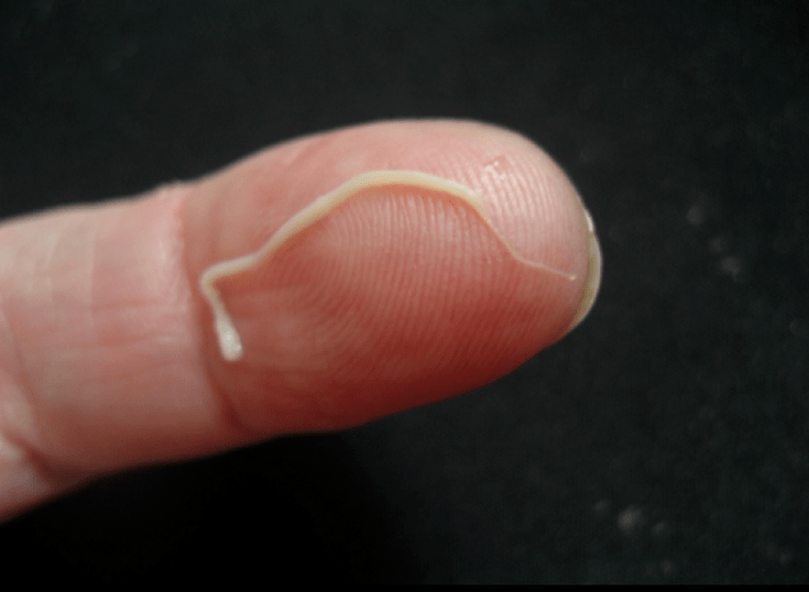 Spulwurm, Parasit des menschlichen Körpers